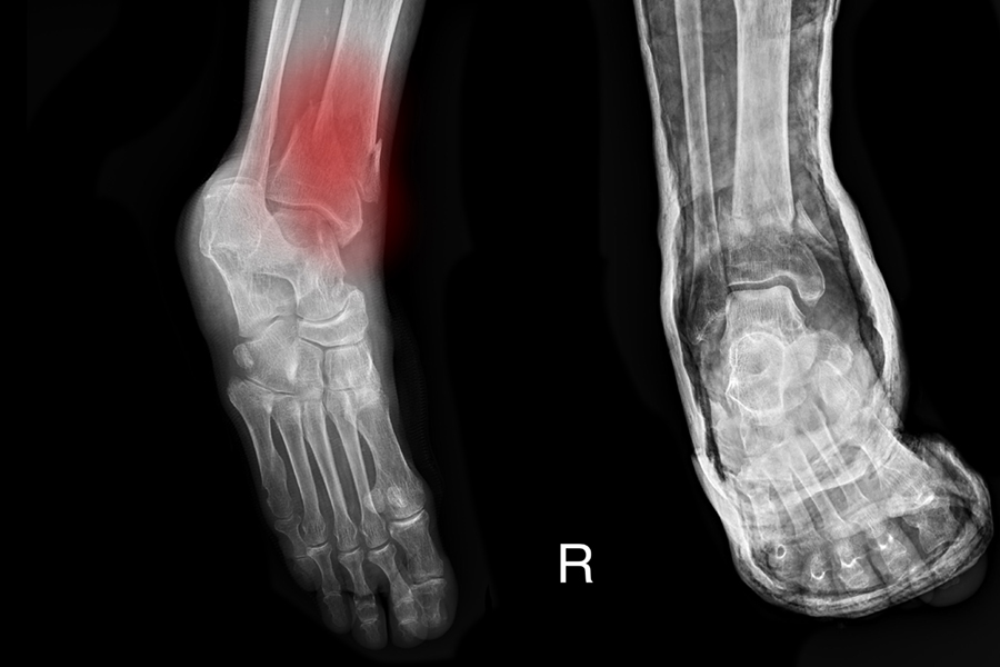 Ankle Fracture, Broken Ankle Specialist