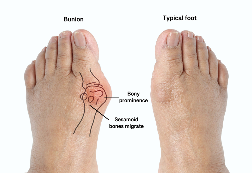 Bunion Treatment Sellersville | Hammertoe Blue Bell, Feasterville